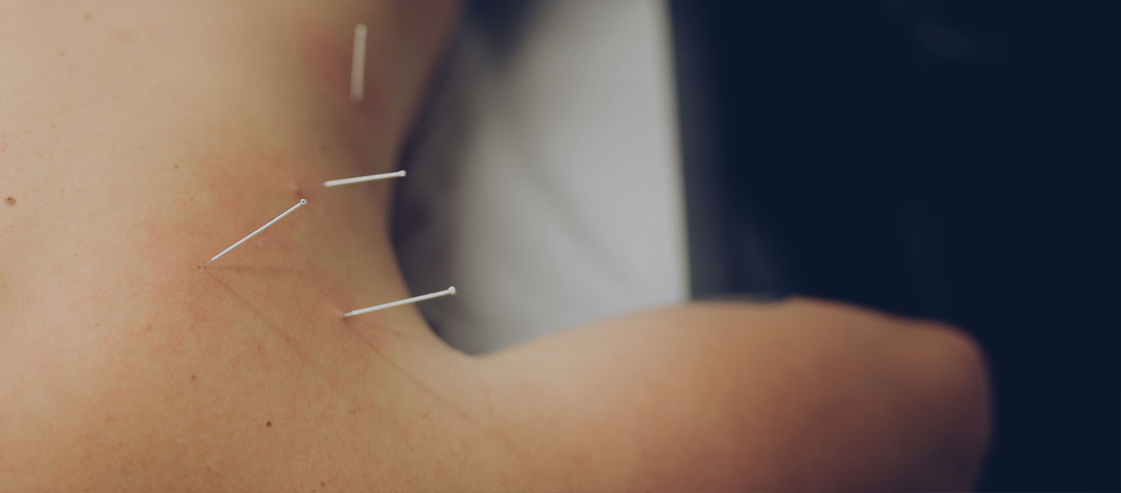 Bilde av akupunktur